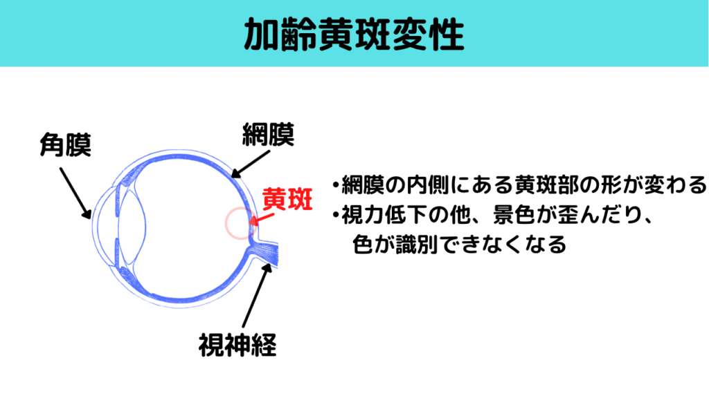 加齢黄斑変性